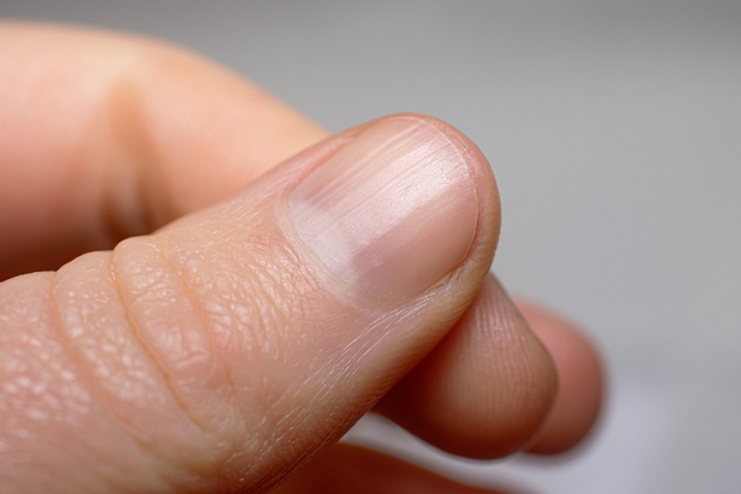 Причины неровности ногтей