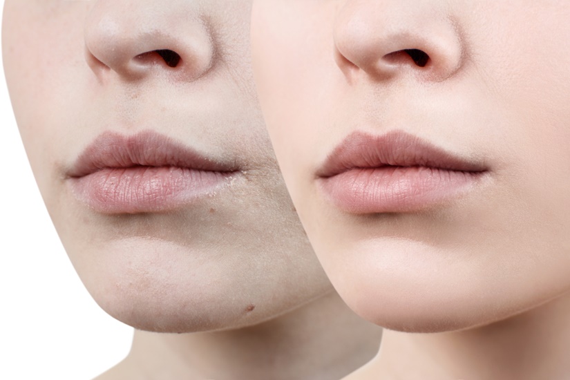 Увлажнение губ без увеличения: до и после