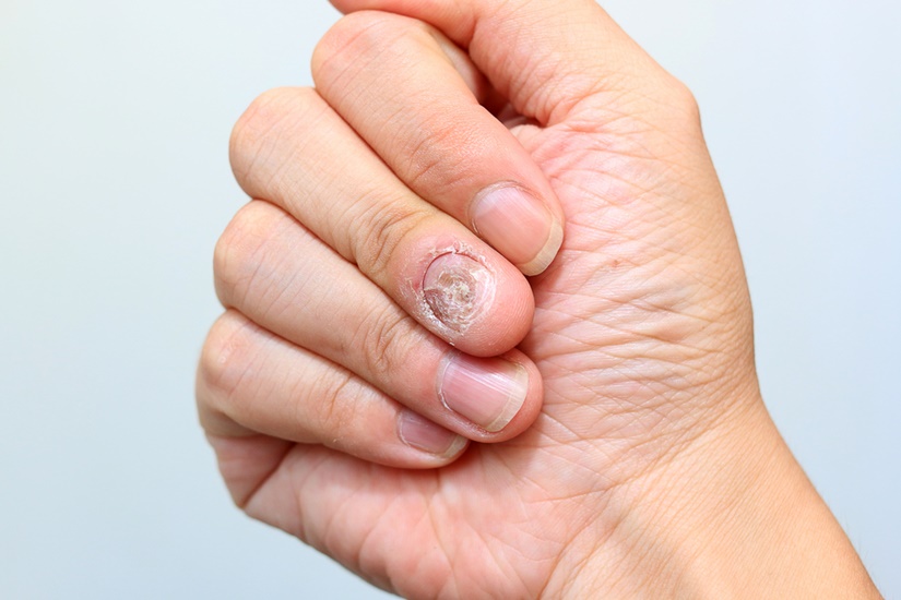 Диагностика грибка ногтей на руках