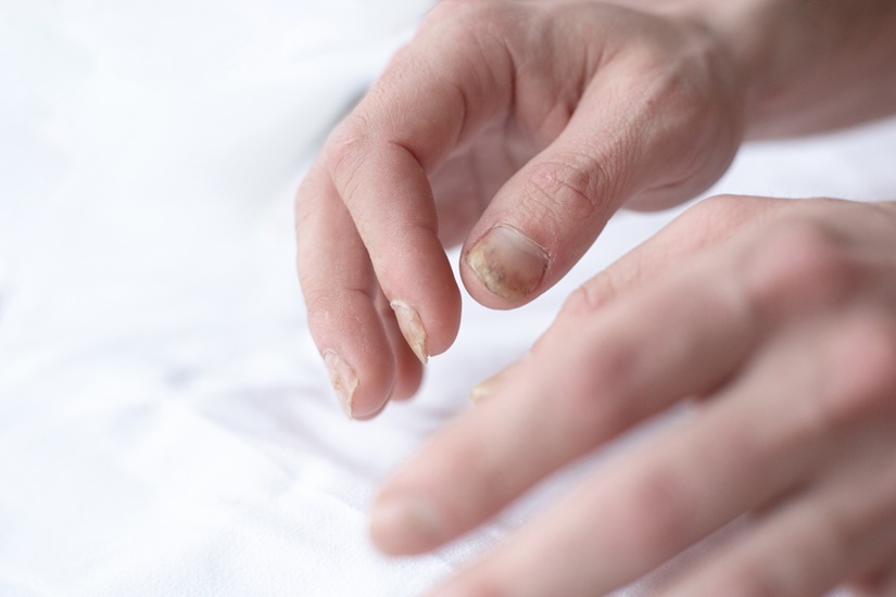Как вылечить грибок на ногтях рук