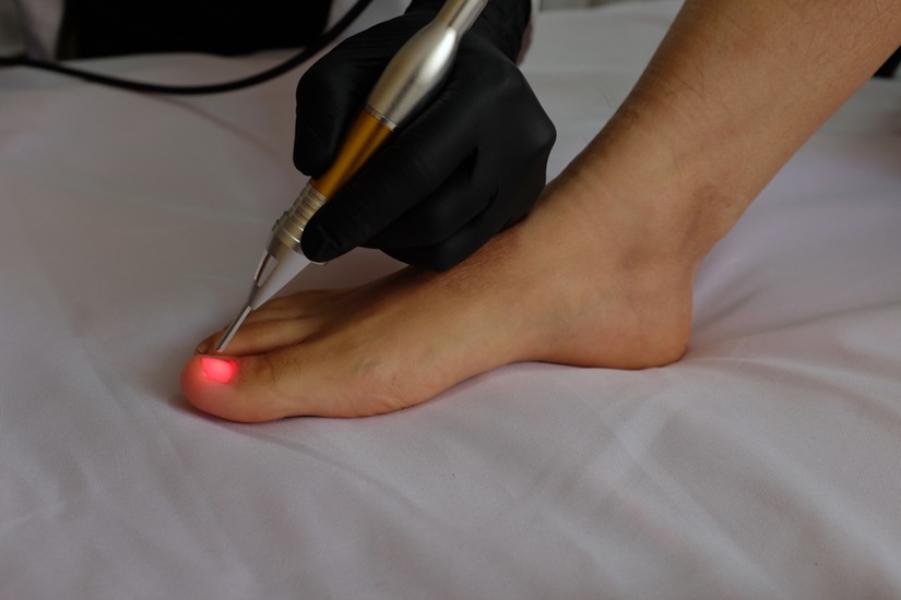 Лазерный способ коррекция вросшего ногтя