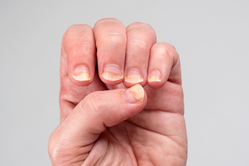 Онихомикоз (грибок ногтей) - причины, симптомы и лечение
