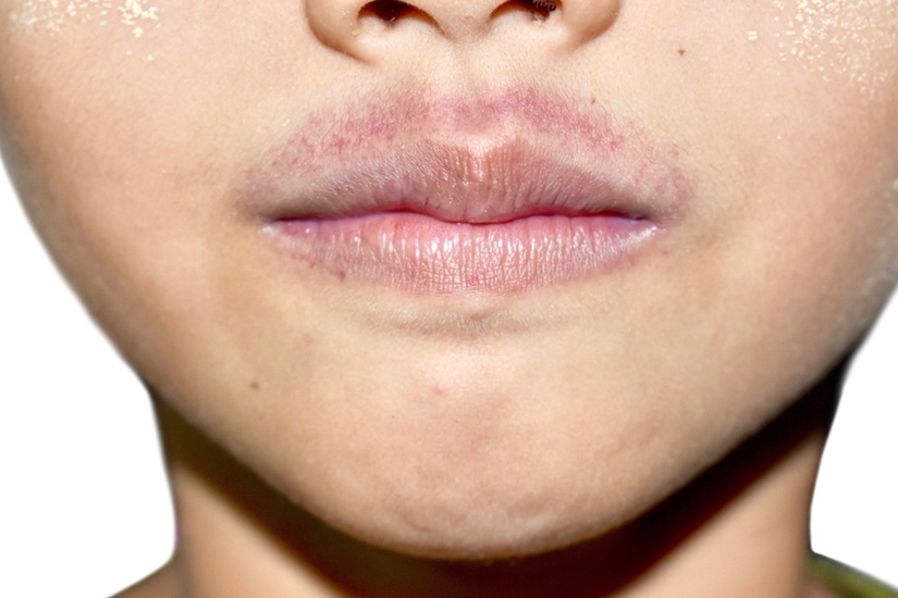 Как избавиться от пигментации вокруг рта: косметологические методы  коррекции пигментных пятен над верхней губой